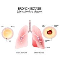 Bronchiectasis. Normal bronchus and bronchiectasis. enlarged small airways that collect mucus and cause recurrent lung infections. obstructive lung disease.